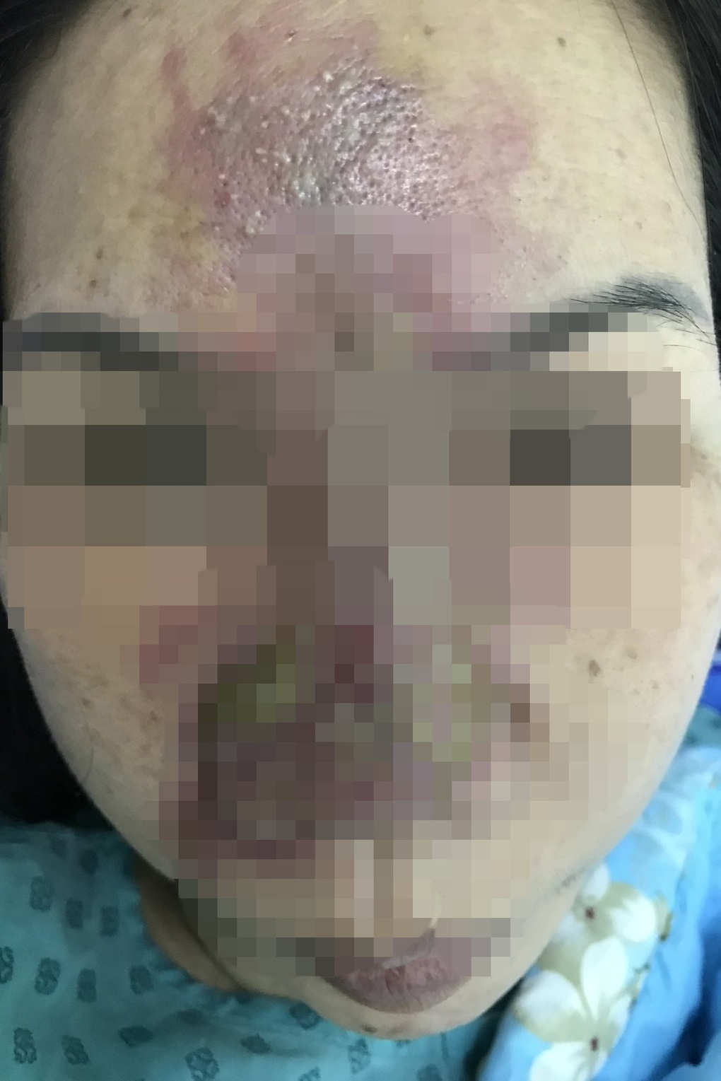 Đi cắt mí tại thẩm mỹ viện, người phụ nữ thủng 4 lỗ ở mắt, vỡ thủy tinh thể - 2 Đi cắt mí tại thẩm mỹ viện, người phụ nữ thủng 4 lỗ ở mắt, vỡ thủy tinh thể - 2