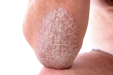 Phương pháp giúp cải thiện triệu chứng vảy nến được nhiều người áp dụng