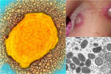 Bệnh đậu mùa khỉ lan ra trên 30 nước, hơn 550 ca mắc