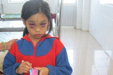 Cặp vợ chồng đánh con gái nuôi dã man 