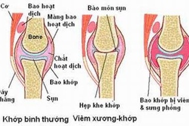 Nguyên nhân và giải pháp điều trị viêm khớp dạng thấp