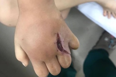 Bé gái 4 tuổi bị khỉ nhà hàng xóm cào rách tay, chảy mủ