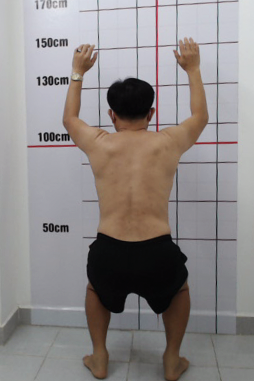 Thấy tê bì tay chân: Coi chừng liệt vận động, mất khả năng tình dục - 1 Thấy tê bì tay chân: Coi chừng liệt vận động, mất khả năng tình dục - 1