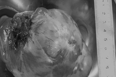 Khó thở, đau ngực vì khối u to như quả cam chèn ép tim phổi