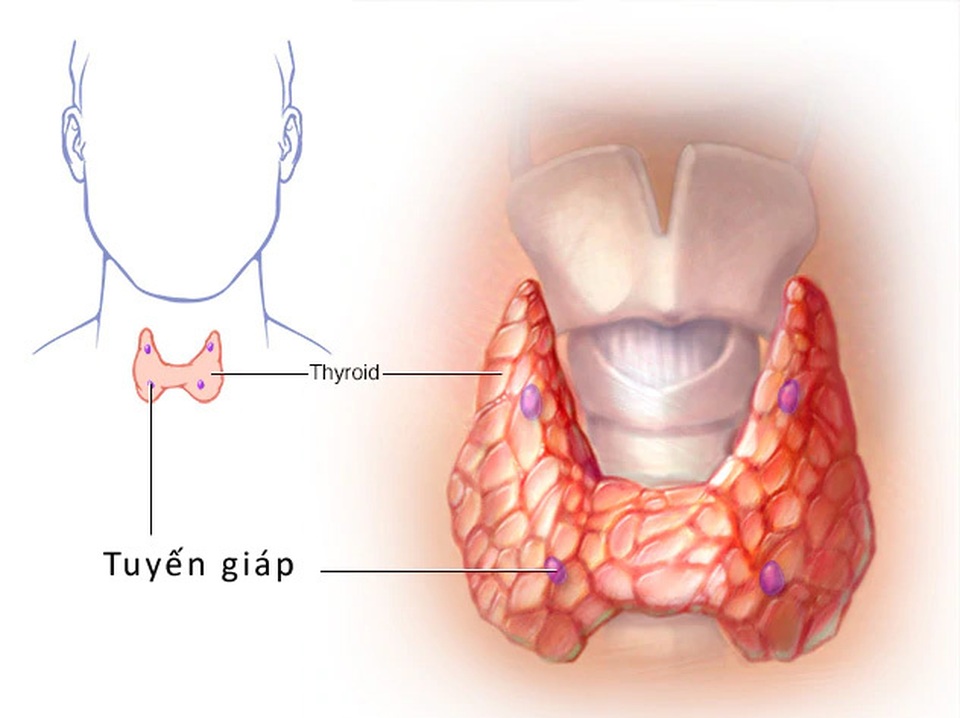 Căn bệnh ung thư nữ MC Quỳnh Chi mắc phải phát triển âm thầm - 2 Căn bệnh ung thư nữ MC Quỳnh Chi mắc phải phát triển âm thầm - 2