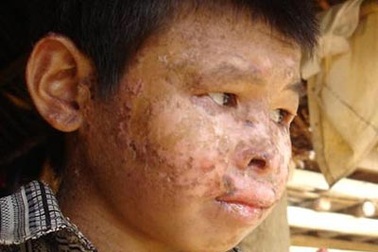 Khô da sắc tố - Thủ phạm gây bệnh ngứa “điên” ở Hòa Bình 