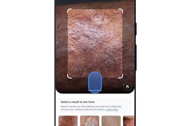 Google cho phép người dùng xác định tình trạng bệnh da liễu thông qua ảnh
