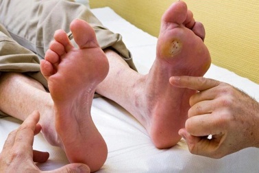 Biến chứng tiểu đường ở chân - làm sao để hạn chế?