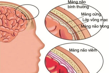 Bé 5 tuổi tử vong do viêm màng não mủ, lấy mẫu xét nghiệm 35 trẻ cùng lớp