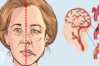 Bí quyết 1000 năm của Nhật Bản dành cho người tai biến