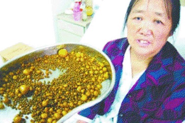 Hơn 2.000 viên sỏi trong túi mật “khổng lồ”