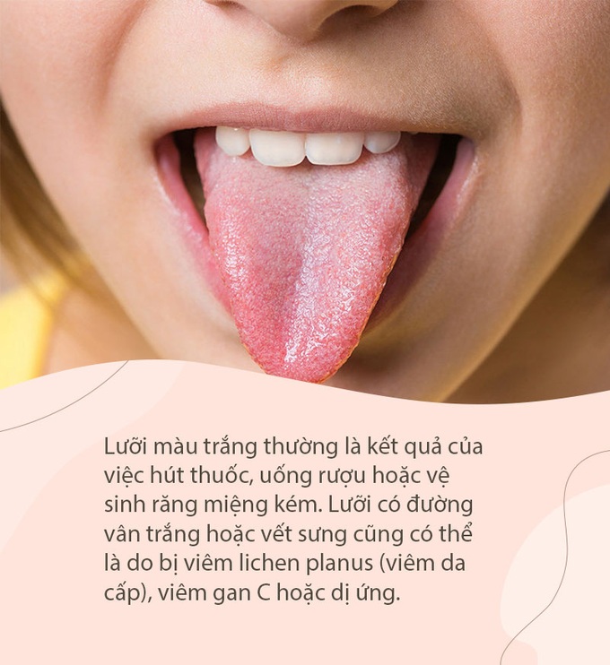 Người trẻ tuổi hiện đại thường không thể sống thiếu cà phê, nhưng nếu thấy dấu hiệu này xuất hiện ở lưỡi thì cần phải hạn chế lại ngay - Ảnh 4. Người trẻ tuổi hiện đại thường không thể sống thiếu cà phê, nhưng nếu thấy dấu hiệu này xuất hiện ở lưỡi thì cần phải hạn chế lại ngay - Ảnh 4.