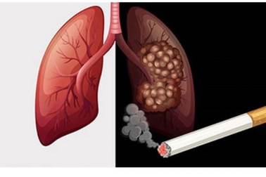 90% người bệnh mắc loại ung thư gây tử vong hàng đầu liên quan đến thuốc lá