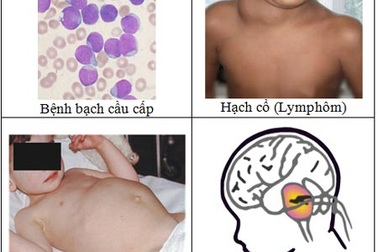 Ung thư trẻ em: Cha mẹ mới nhận ra bệnh!