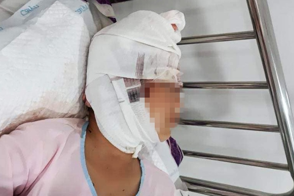 Bẫy chuột kiếm tiền phụ cha, bé gái 13 tuổi bị máy tuốt lúa lóc sạch da đầu - 1 Bẫy chuột kiếm tiền phụ cha, bé gái 13 tuổi bị máy tuốt lúa lóc sạch da đầu - 1