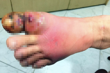 Căn bệnh hiểm khiến 25% người mắc bị cắt cụt chi, 40% tử vong