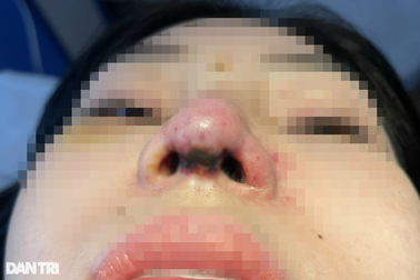 "Bác sĩ tiktok" sửa mũi 100 triệu đồng, cô gái xinh đẹp bị tai biến nặng nề