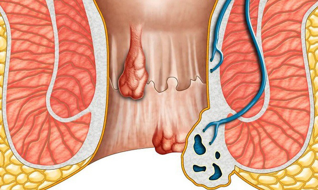 Triệu chứng ung thư hậu môn giai đoạn đầu - 1 Triệu chứng ung thư hậu môn giai đoạn đầu - 1
