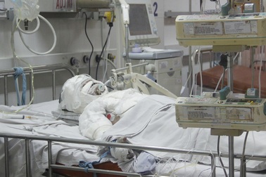 Nhiều trẻ tử vong, nguy kịch vì bỏng do người lớn sơ ý