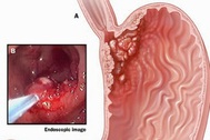 7 dấu hiệu cảnh báo ung thư dạ dày đã ở giai đoạn muộn