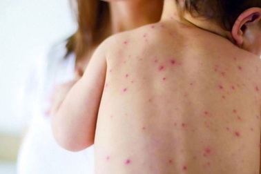 Trời nồm ẩm: 3 việc cần làm ngay để phòng bệnh lúc giao mùa