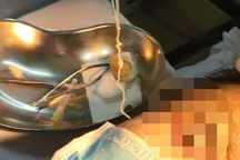 Con giun dài 10cm sống trong mắt nữ bệnh nhân