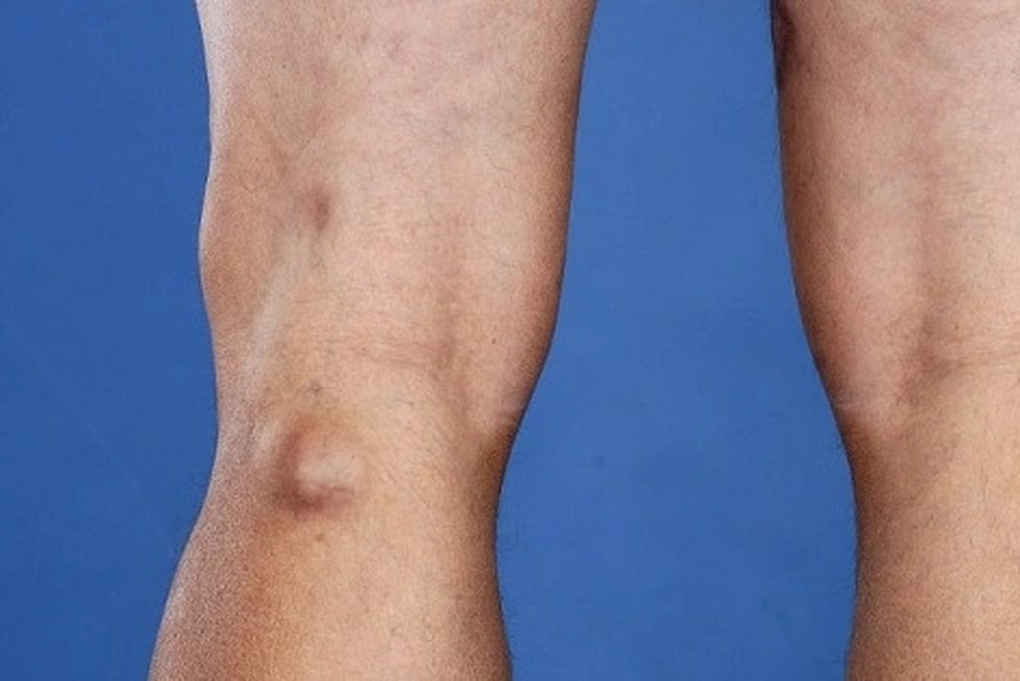 Khớp gối đột nhiên căng phồng: Cảnh giác với căn bệnh này - 1 Khớp gối đột nhiên căng phồng: Cảnh giác với căn bệnh này - 1