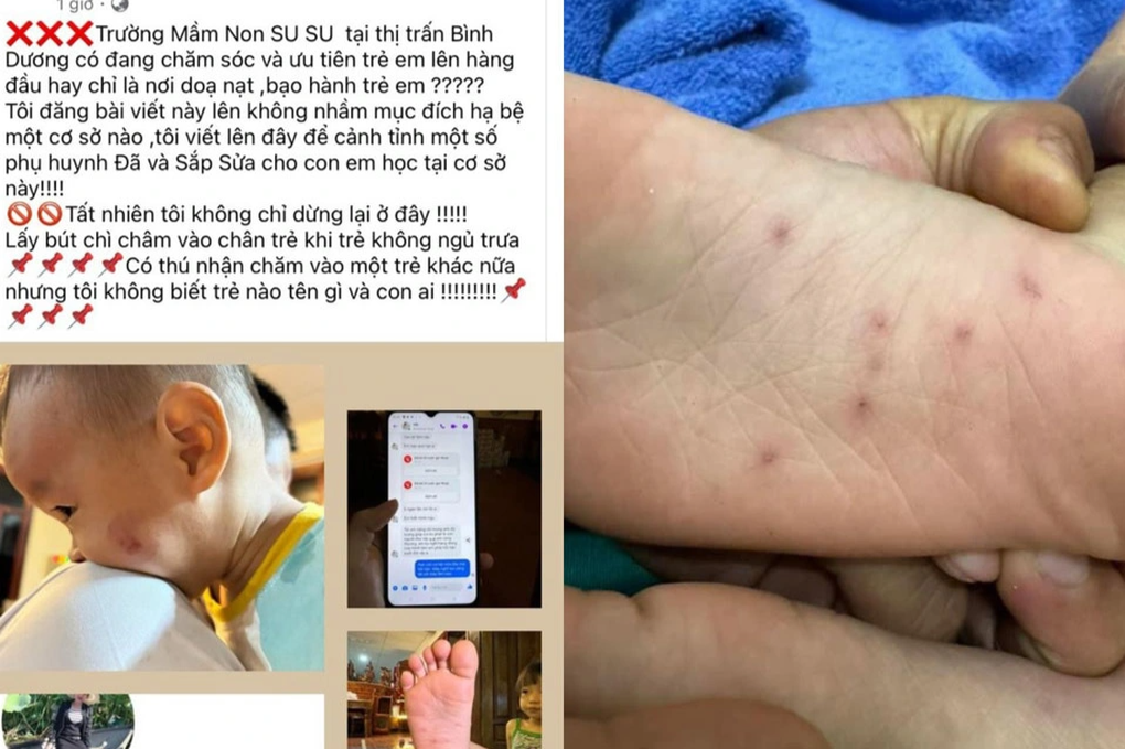 Liên tiếp 2 trẻ mầm non bị bạo hành, công an vào cuộc - 1 Liên tiếp 2 trẻ mầm non bị bạo hành, công an vào cuộc - 1