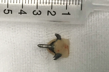 Súc miệng đi ngủ, cô gái suýt chết vì rơi răng giả xuống phổi