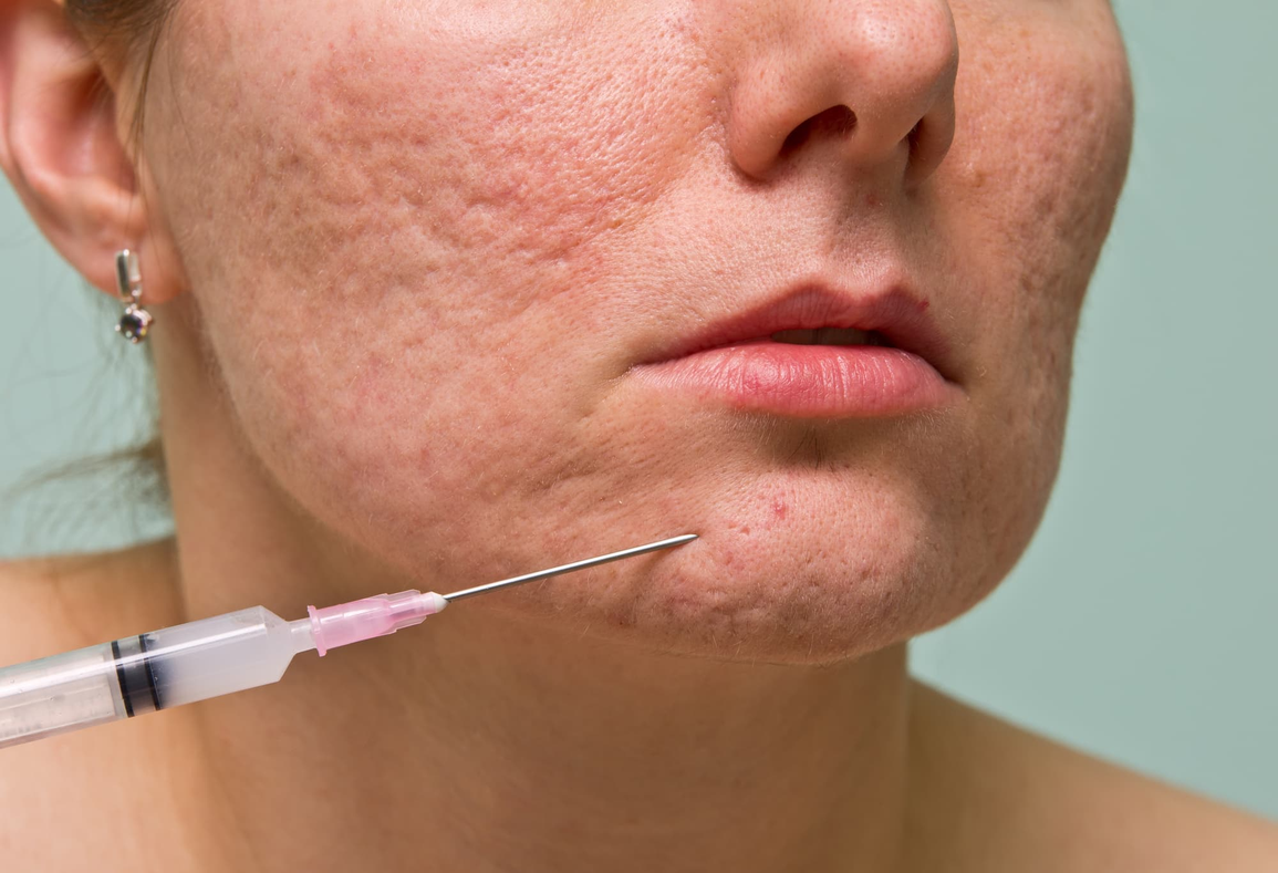 Rejuvaskin - phương pháp điều trị sẹo không xâm lấn - 1 Rejuvaskin - phương pháp điều trị sẹo không xâm lấn - 1