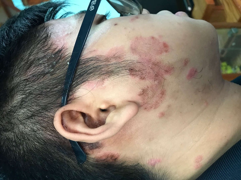 Sinh viên y khoa đẩy lùi bệnh vảy nến nhờ thuốc sinh học - 1 Sinh viên y khoa đẩy lùi bệnh vảy nến nhờ thuốc sinh học - 1