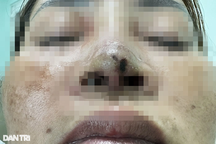 Xử phạt phòng khám sau phản ánh "mẹ 2 con sửa mũi hoại tử" của báo Dân trí