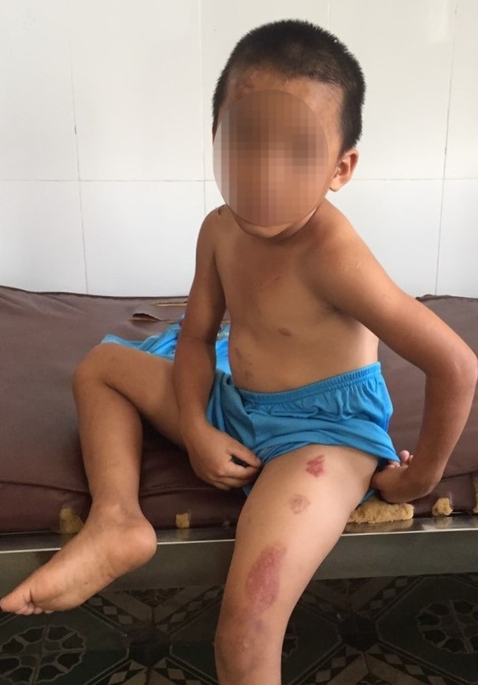 Nghi án bé trai bị cha dượng dùng dao cắt thịt, dí thuốc lá cháy vào mặt - 1 Nghi án bé trai bị cha dượng dùng dao cắt thịt, dí thuốc lá cháy vào mặt - 1