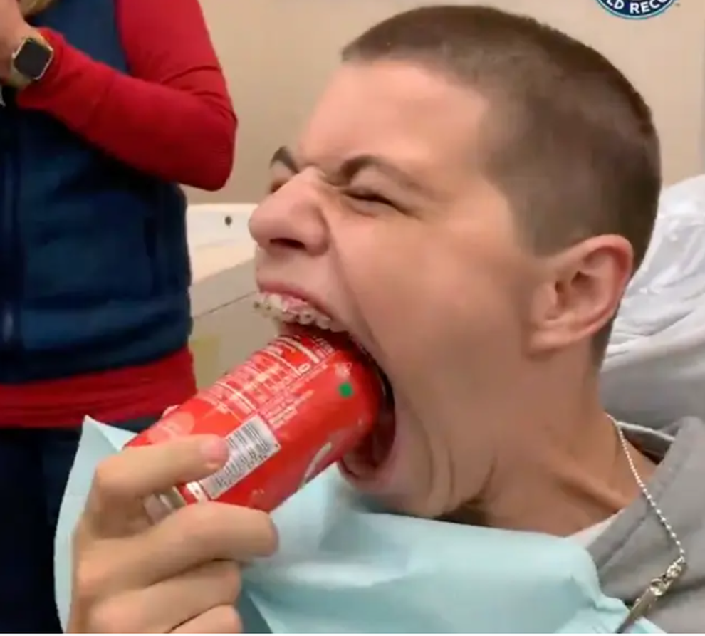 Thiếu niên có miệng rộng nhất hành tinh - 2