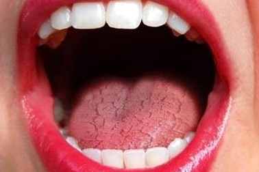 Chứng khô miệng ở bệnh nhân ung thư