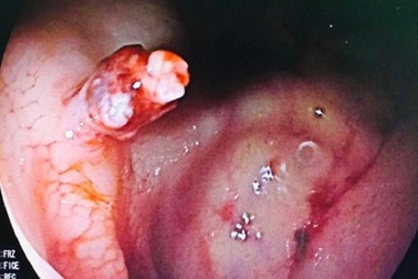 Người đàn ông đi cầu ra máu ồ ạt vì bệnh lý hiếm gặp