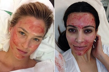 Kinh hãi với trào lưu làm đẹp bằng... máu