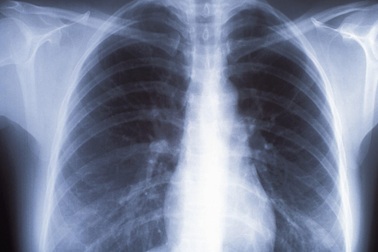 Tỷ lệ nữ giới châu Á không hút thuốc mắc ung thư phổi tăng