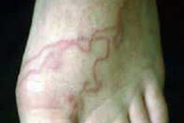 Khoảng 60 triệu người Việt Nam nhiễm giun đũa 