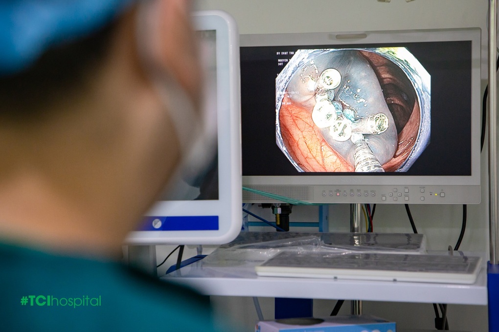 Không triệu chứng, người phụ nữ bất ngờ phát hiện 9 polyp đại tràng sau nội soi - 2 Không triệu chứng, người phụ nữ bất ngờ phát hiện 9 polyp đại tràng sau nội soi - 2