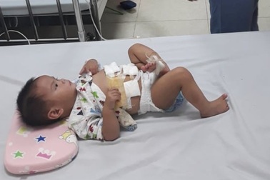 Mổ cứu sống thành công bé gái 10 tháng tuổi có nang ống mật chủ cực lớn