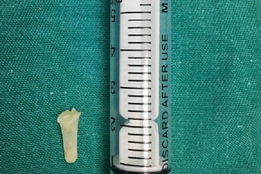 Trẻ 9 tháng tuổi thở rít sau hóc xương cá nhiều ngày