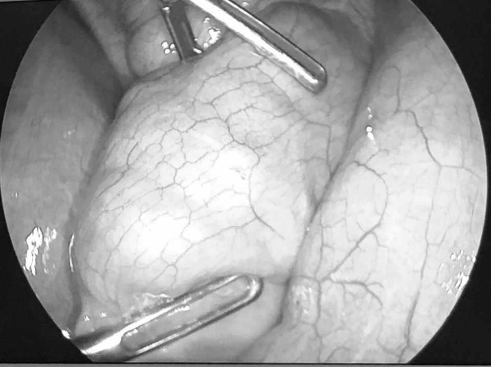 Mê ăn vặt cổng trường, bé 8 tuổi tắc ruột vì nhiều khối bã thức ăn - 1