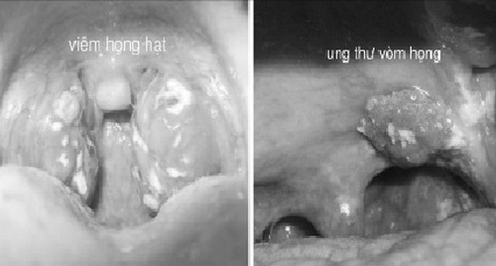 Cách phân biệt ung thư vòm họng và viêm họng - 1 Cách phân biệt ung thư vòm họng và viêm họng - 1