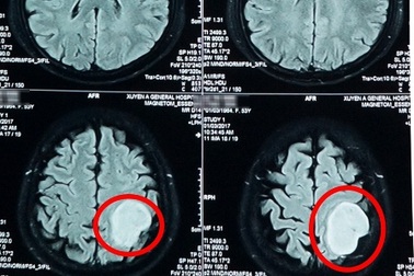 "Quả bóng tennis" nằm trong não bệnh nhân
