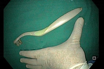 Nữ sinh viên nuốt bàn chải đánh răng dài 20cm do bị ngã