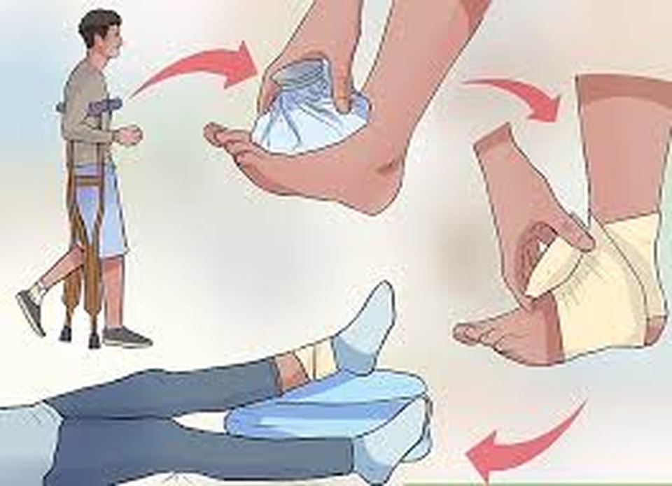 Đừng chủ quan khi bị bong gân, chảy máu... - 1 Đừng chủ quan khi bị bong gân, chảy máu... - 1