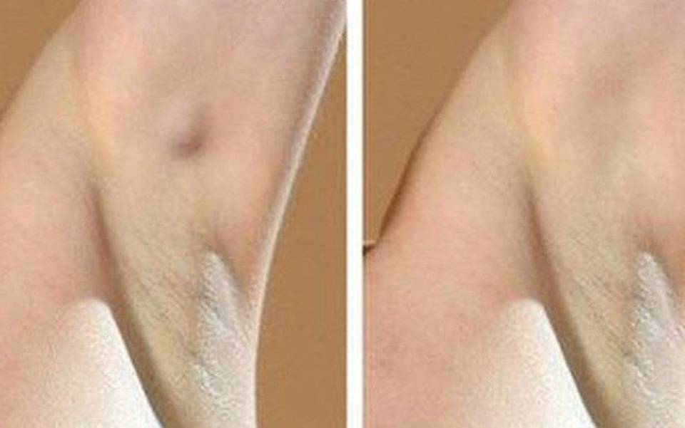 Nổi hạch ở nách lâu ngày không hết có đáng ngại? - 2 Nổi hạch ở nách lâu ngày không hết có đáng ngại? - 2