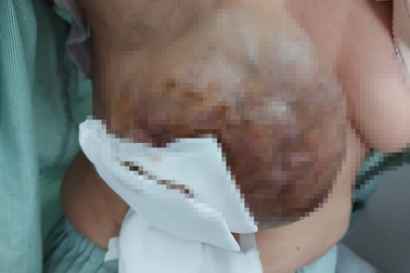 Hoảng hồn vú sùi loét, phun máu thành tia sau 20 năm tự điều trị ung thư