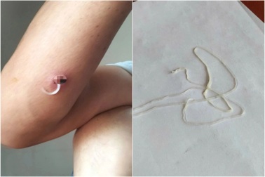 Cảnh báo: Nhiễm giun rồng nguy hiểm do ăn món "đặc sản" gỏi cá